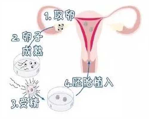 商业化成都代孕,不孕专家王雷什么是输卵管造影